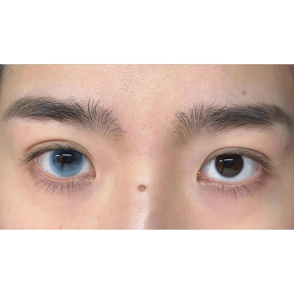 BLLAN thestarlens 14.50mm Blue Colored Contact Lenses (6 Months Wear)